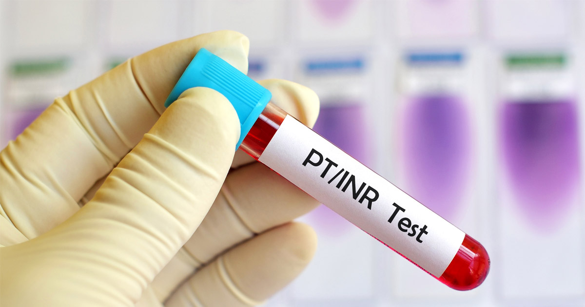 Blood sample for PT INR test, diagnosis for coagulation disease