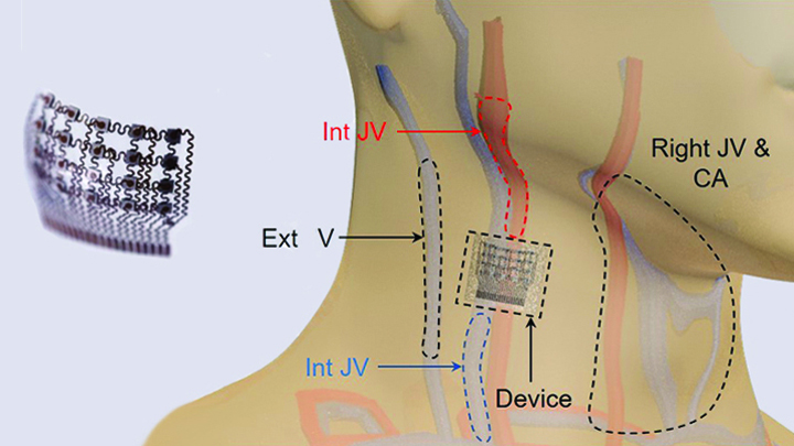 Placement of the blood pressure patch