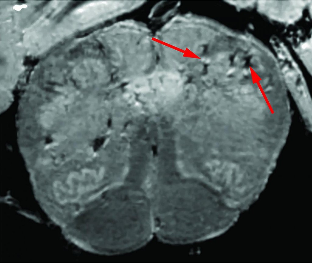 MRI of a brain damaged by COVID-19