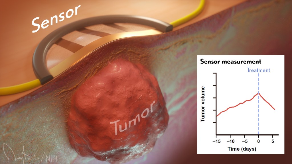 A labeled sensor rests on the surface of the skin. Under the sensor, beneath the skin in a tumor. A graph shows the tumor's size over time.